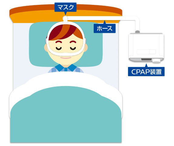 CPAP（シーパップ）療法