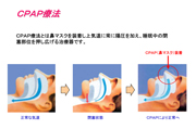 CPAP療法